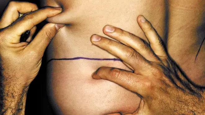 Una de cada cuatro cirugías estéticas entre los hombres de Estados Unidos es una liposucción.