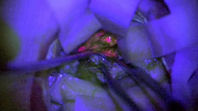 يمكن الاعتماد على الإفرازات الوردية في التمييز بين الخلايا السرطانية والأنسجة السليمة في المخ لأن الخلايا لا تستطيع تكسيرها