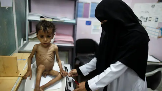 يعاني ملايين اليمنيين وعلى رأسهم الاطفال والنساء من المجاعة