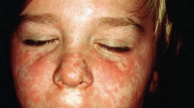 Сыпь от кори на лице