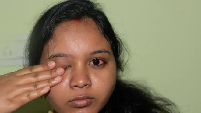 গ্লুকোমা