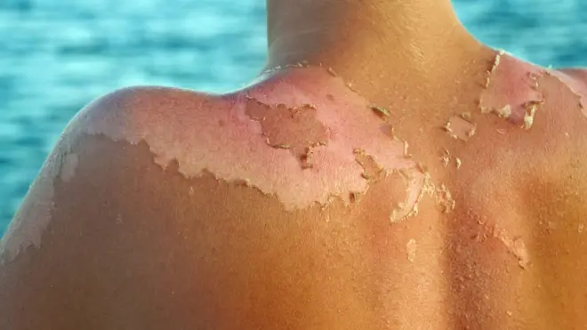 Exponerse demasiado al sol o hacerlo sin la protección adecuada puede tener consecuencias desagradables...