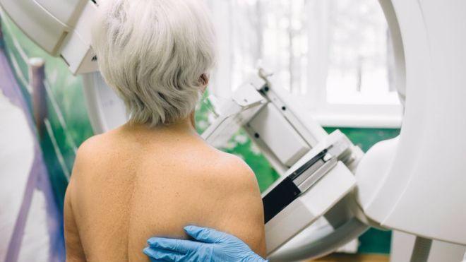 انخفضت نسبة الكشف عن سرطان الثدي في بريطانيا بنسبة 70 بالمئة منذ إعلان الإغلاق العام