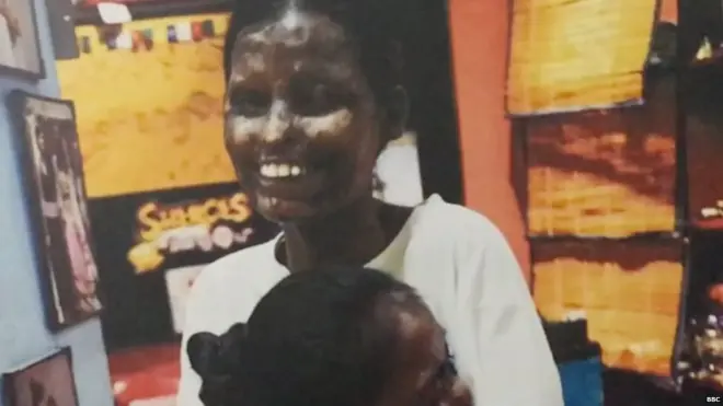 एसिड अटैक सर्वाइवर