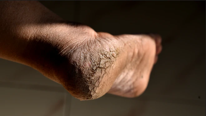 శీతాకాలం, చలిగాలులు, కాలి మడమలలో పగుళ్లు