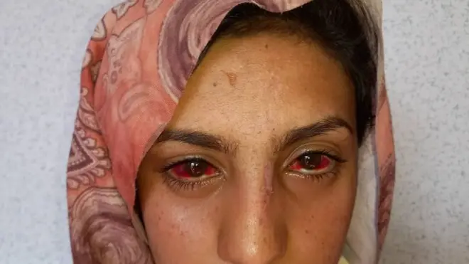 A women with swollen red eyes