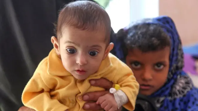 పోషకాహారా లోపంతో బాధపడుతున్న చిన్నారి