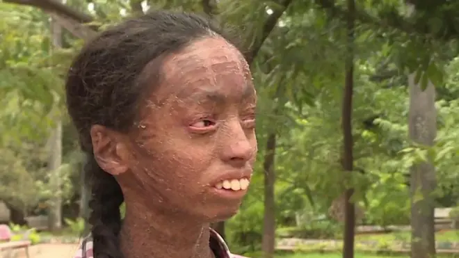 Devojčica sa poremećajem kože