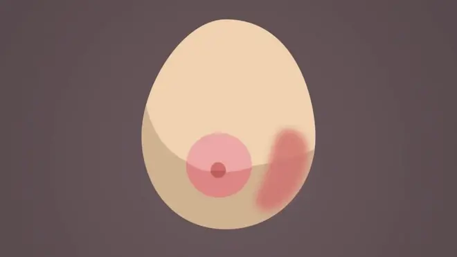 Un pecho irritado o inflamado.