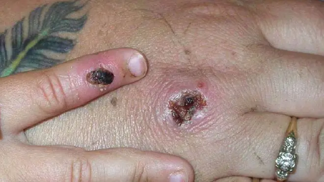 A monkeypox lesion