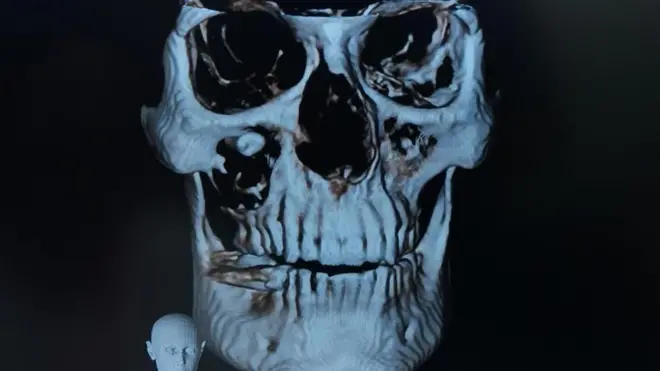 వైద్యం, ఆపరేషన్, బిహార్, సీబీసీటీ