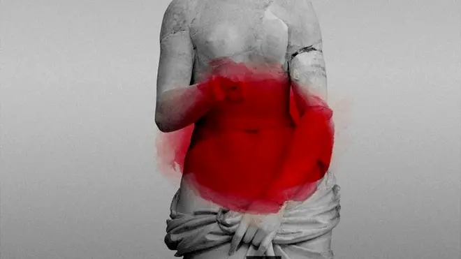 ਐਂਡੋਮੇਟ੍ਰਿਓਸਿਸ