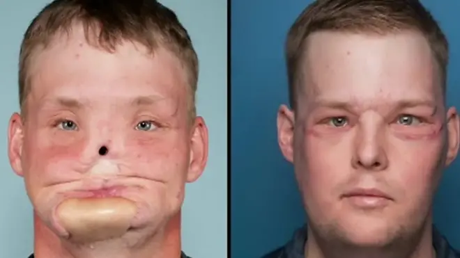 Lilly Ross había donado varios órganos, incluyendo el rostro, de su esposo que se suicidó cuando llevaban un año de casados