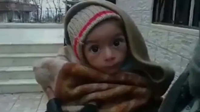 マダヤでやせほそった赤ちゃん