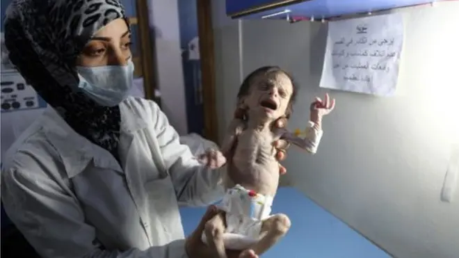 وفاة رضيعة بسبب سوء التغذية في سوريا يهز تويتر