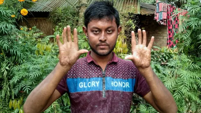 వీరి కుటుంబంలో నాలుగు తరాల వారికి చేతి వేలి ముద్రలు లేవు