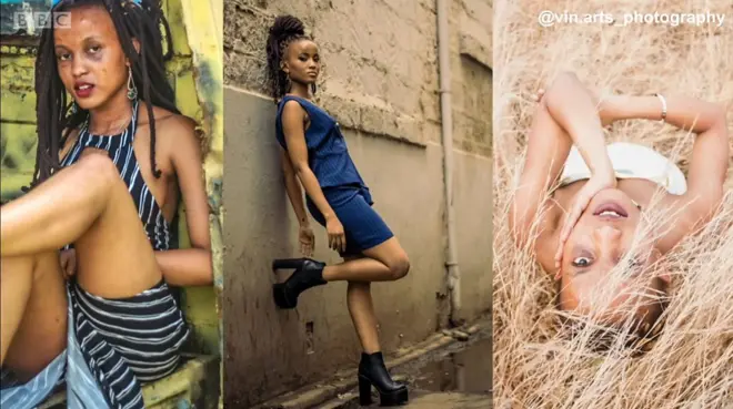 모델로 활동하는 화상 피해자 클라우디아