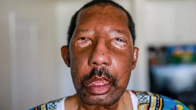 로버트 첼시는 흑인 최초로 안면 이식 수술을 받았다