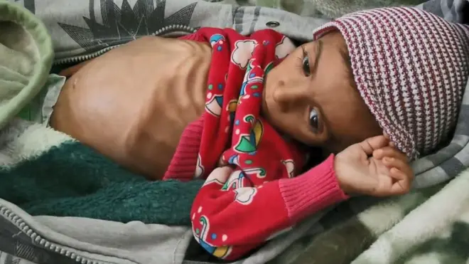 Anak kelaparan di Yaman