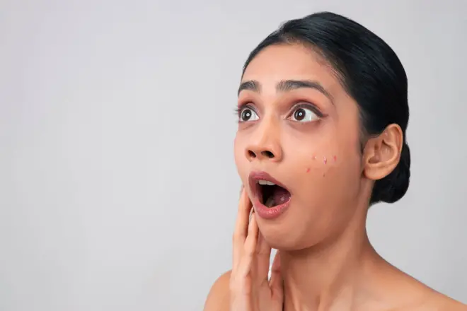 चेहऱ्यावरची मुरमं-पिंपल्स थुंकी लावून जातात? पिंपल्स का येतात? थुंकी औषधी असते का?