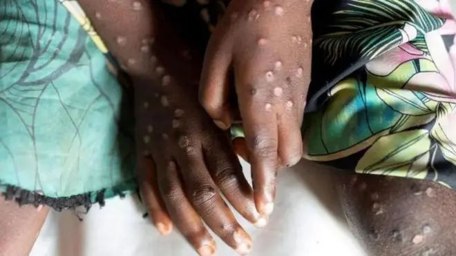 Kiis cusub ah ayaa lagu xaqiijiyay Iswidhan toddobaadkii hore waxaana lala xiriiriyay faafitaanka sii kordhaya ee Afrika.