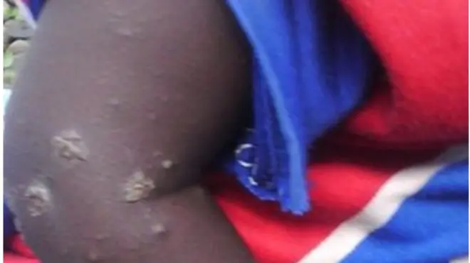 Sawirrada qaar ka mid ah carruurta la sheegay in ay waxyeelada ka soo gaartay hubkaasi kiimikada ah