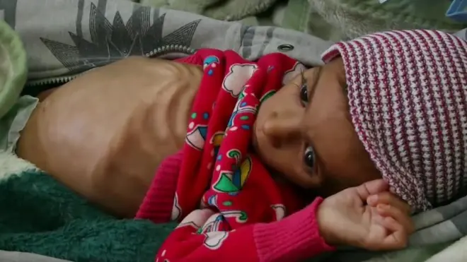 Ємену загрожує "найгірший за 100 років" голод