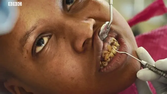 La fluorose dentaire: "Je veux sourire sans honte"