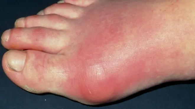 مرض النقرس يصيب واحدا من بين كل 100 شخص في المملكة المتحدة.