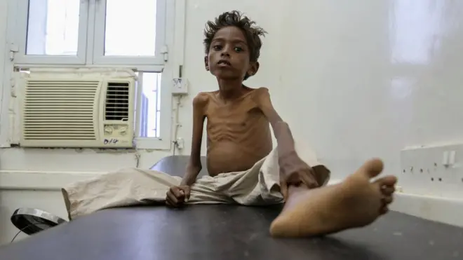 Five-year-old Mohannad Ali sits in hospital in Yemen in December: his younger cousin - aged just two - died of hunger
