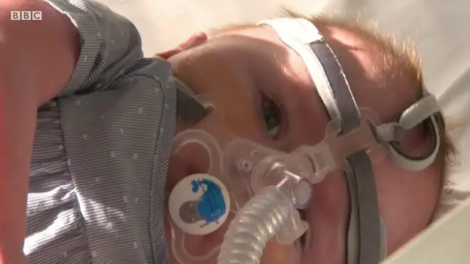 심장을 몸 밖에 달고 태어난 아기