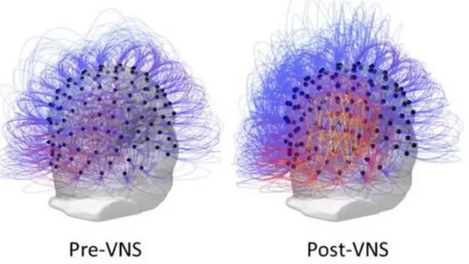根据大脑的超声波检查，没有受到刺激治疗前的大脑（左）和之后的大脑（右）有显著不同。