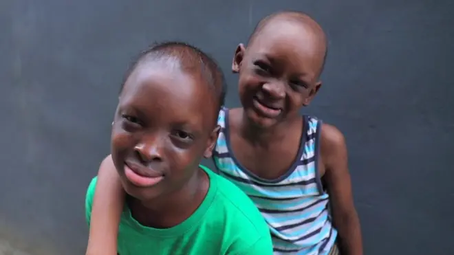 Ectodermal Dysplasia