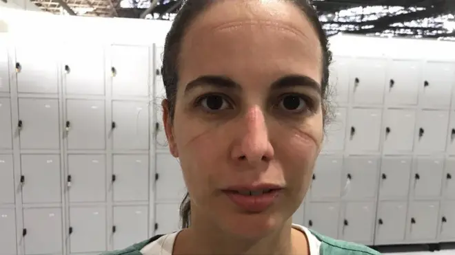 રેનાટાનાં ચેહરા પર માસ્ક દ્વારા છોડવામાં આવેલા નિશાન