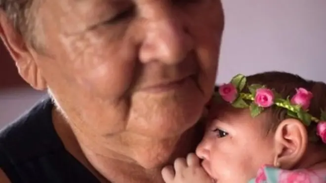 فيروس زيكا ارتبط بصغر حجم الرأس لدى المواليد