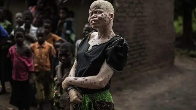 Wanaharakati wanasema hatua hiyo itasaidia kupunguza unyanyapaa dhidi ywa watu walio na ulemavu wa ngozi yaani albinism
