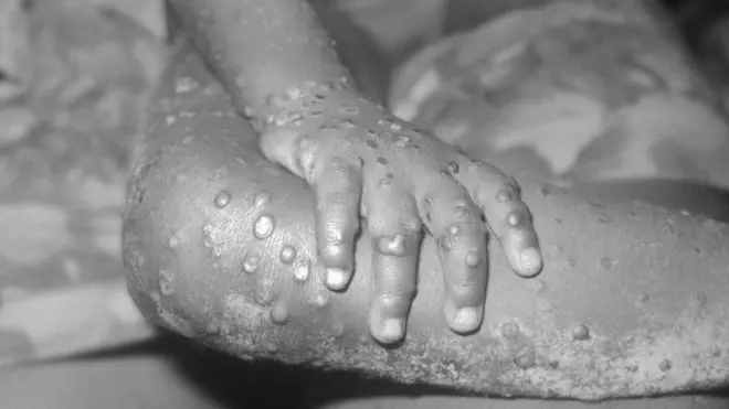 Fiditaanka fayraska monkeypox ayaa ku yar bani'aadanka dhexdooda, balse mararka qaar waa loo dhintaa