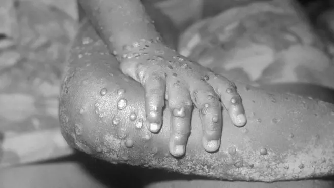Monkeypox lesions