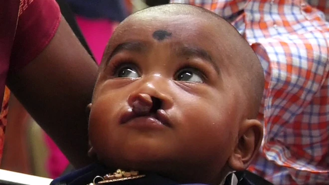 గ్రహణమొర్రి