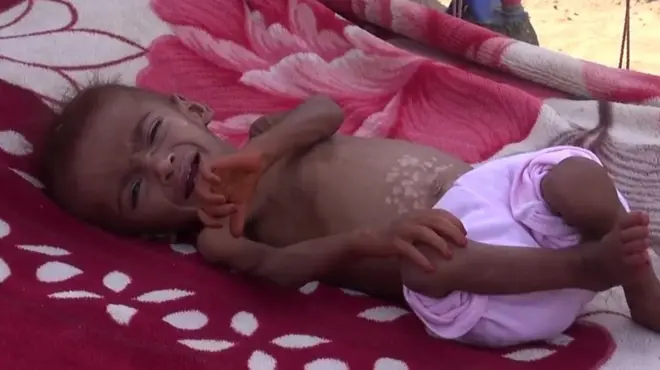 اليمن يواجه "أكبر مأساة إنسانية في العالم"