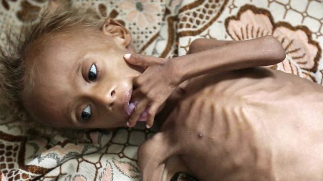 Un millón y medio de niños están desnutridos por la guerra en Yemen. El conflicto, que lleva 18 meses, está empujando al país al borde de una hambruna.