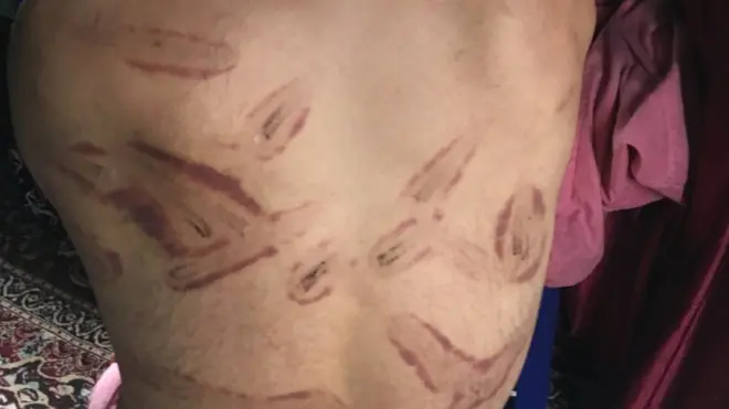 कश्मीर में एक व्यक्ति की पीठ पर टॉर्चर के निशान.