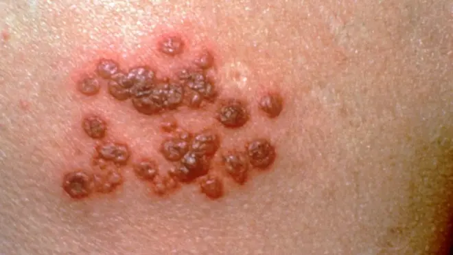 హెర్పెస్ జోస్టర్ లేక షింగిల్స్: