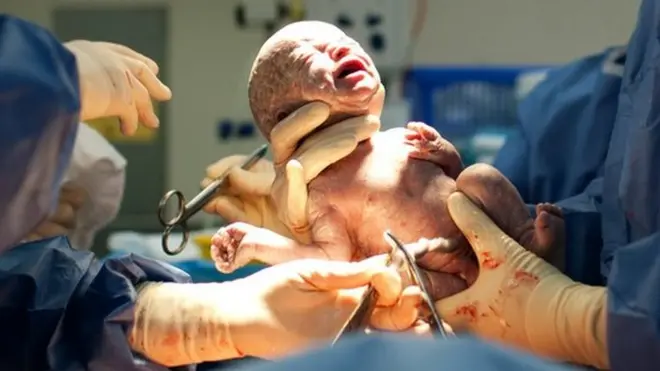 Retrasar el pinzamiento del cordón umbilical es una de las características de una "césarea suave". Foto genérica.