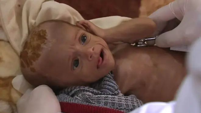 جحيم الأطفال في اليمن بسبب الجوع