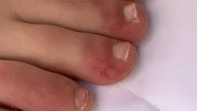 "Kovid barmaqları" donvurma əlamətlərini xatırladır