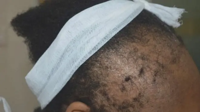 Alopécie : ces coiffures qui nous font perdre nos cheveux !