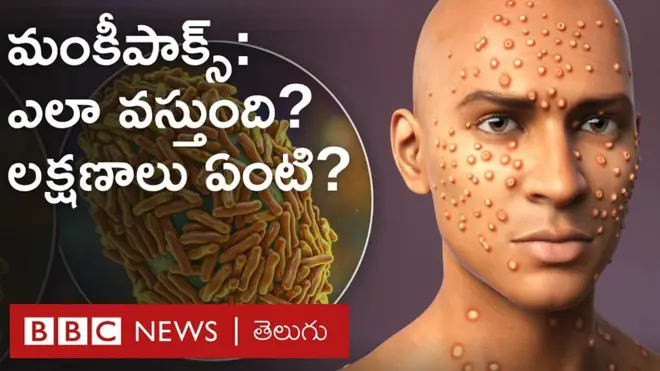 ప్రపంచ ఆరోగ్య సంస్థ చెబుతున్న మంకీపాక్స్ ఎలా వస్తుంది, దీని లక్షణాలేంటి?