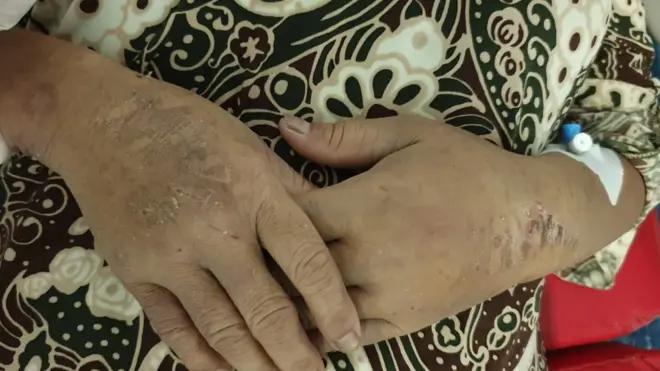 SBMI mengatakan Sulasih antara lain memiliki luka bekas setrika di kedua tangan.