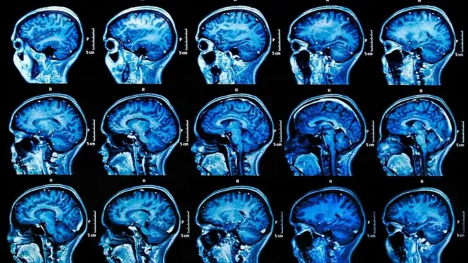 Alzheimer